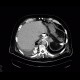Leak of anastomosis of esophagus in pleural cavity, gastroesophageal anastomosis: CT - Computed tomography